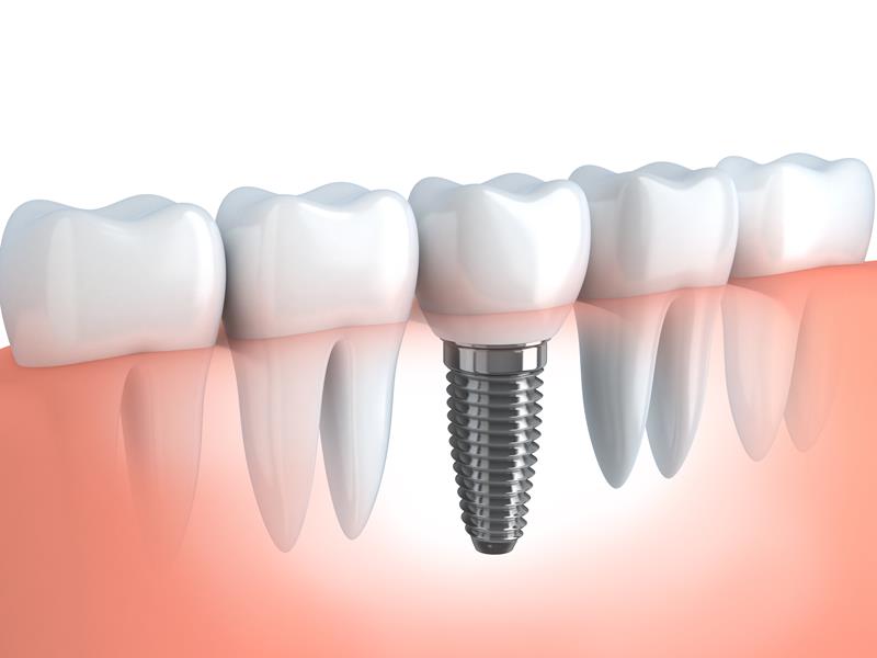Dental Implants Elk Grove, CA
