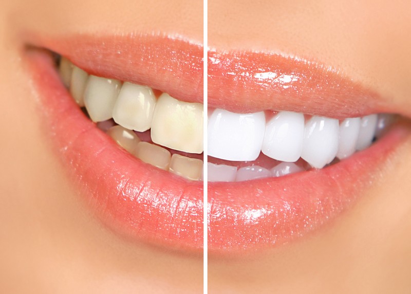 Teeth Whitening Elk Grove, CA